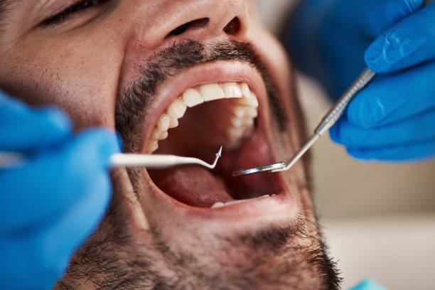 Emergency Dental Filling Replacement in AZ